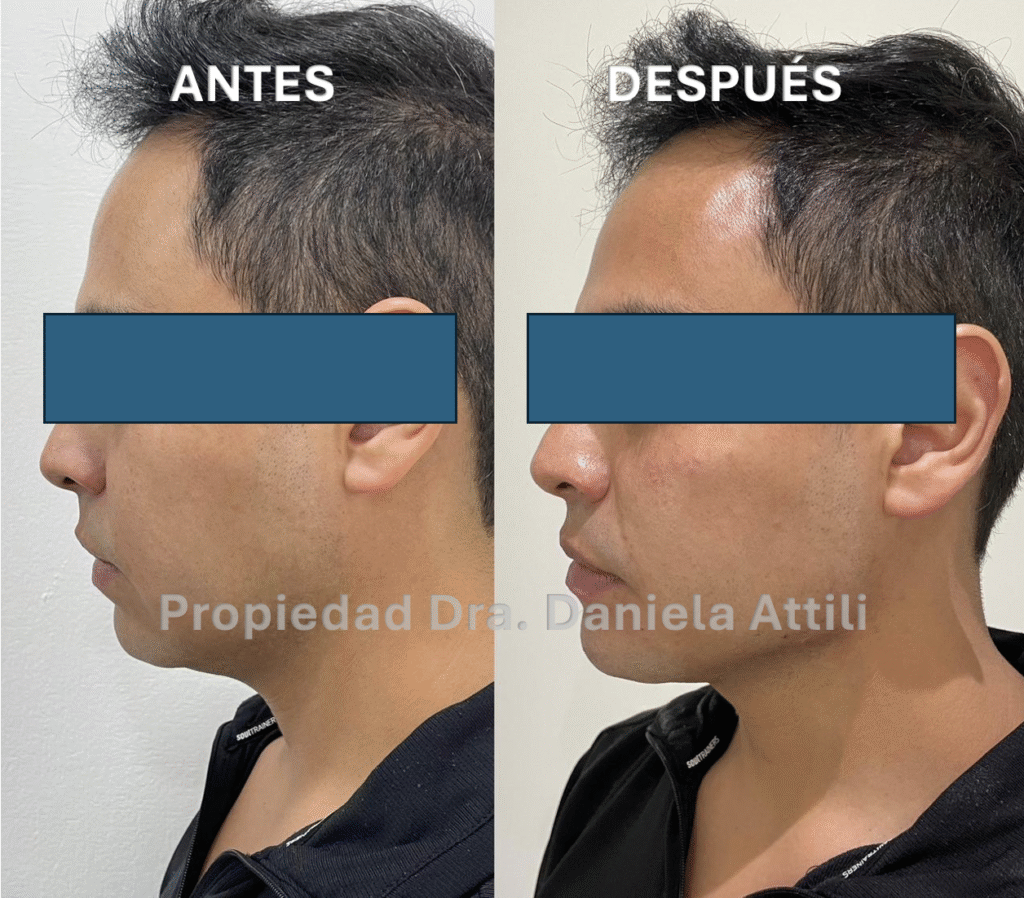 Antes y Después de Perfilamiento Mandibular con ácido hialurónico
